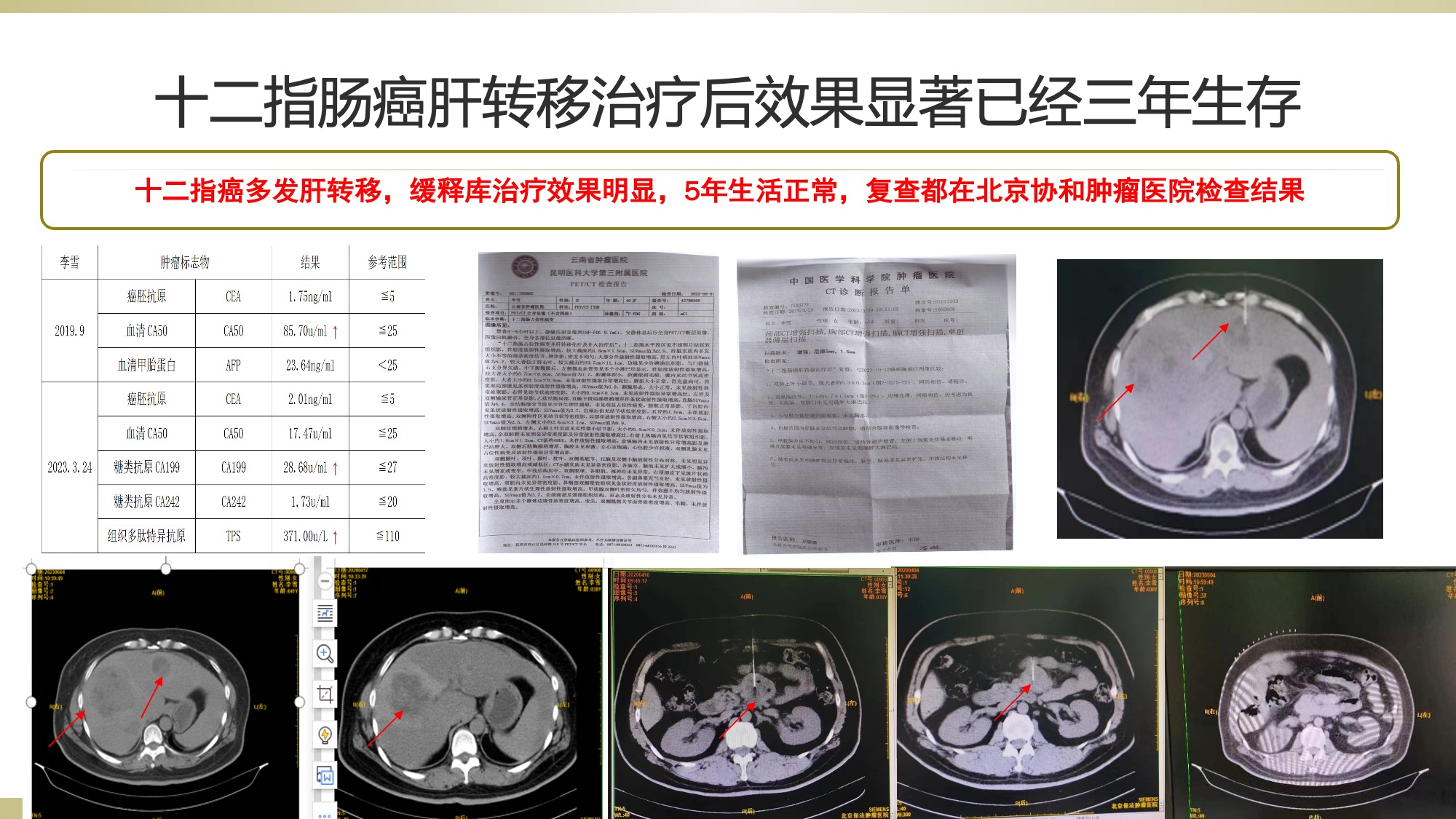 HBV liver cancer treatment outcome